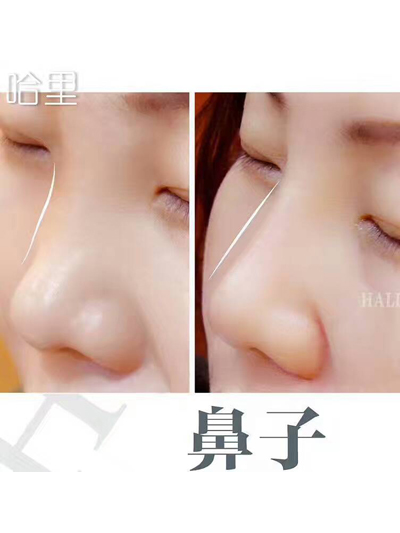 线雕隆鼻