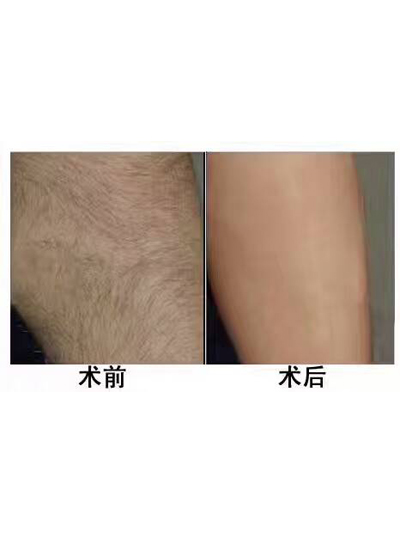 冰点脱毛