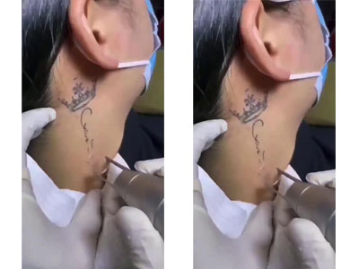 超皮秒洗纹身