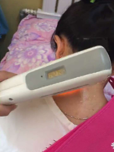 冰点脱毛