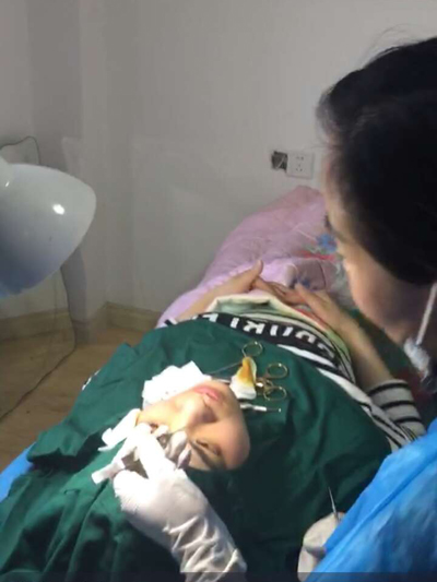 双眼皮