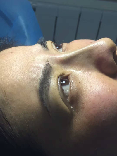 线雕隆鼻