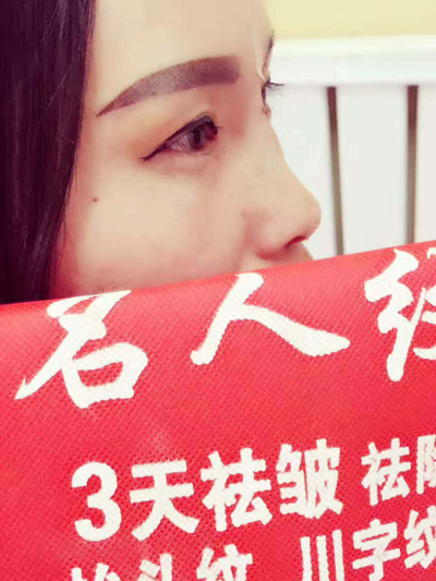 线雕隆鼻